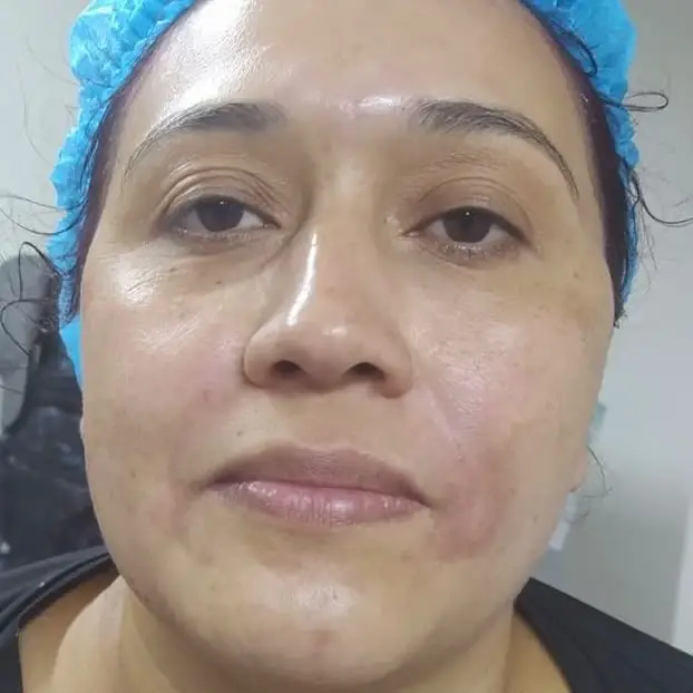 Antes manchas Antes manchas