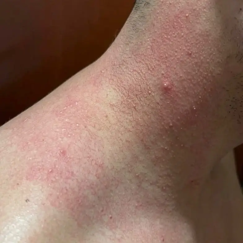 Antes rosacea Antes rosacea