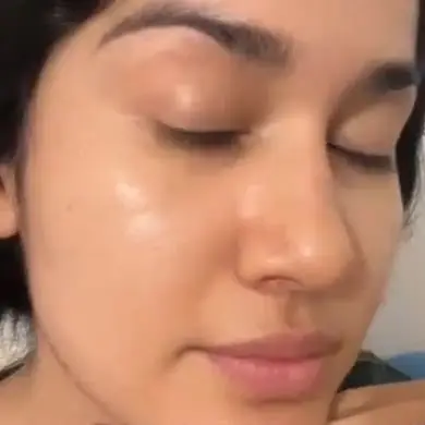 after despues acne