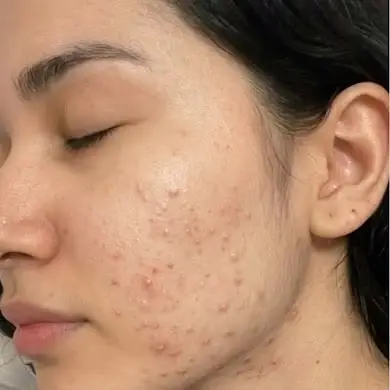 before acne before acne